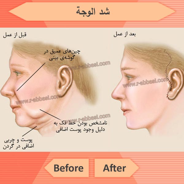 أنواع عمليات شد الوجه وفوائد البشرة والآثار الجانبية والمخاطر