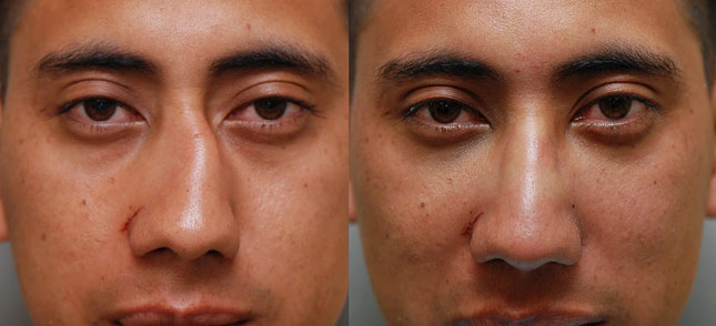 شکستگی-بینی-دکتر عباسی