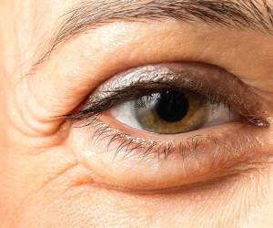درمان-پف-چشم-مزوتراپی-دکتر عباسی